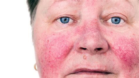 Treating Rosacea On The Face Spot Check Skin Cancer Aesthetics