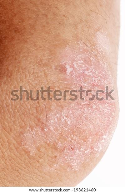 Psoriasis On Elbow Skin Stock Photo 193621460 Shutterstock