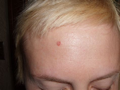 Small Red Bump On Forehead Pictures Photos