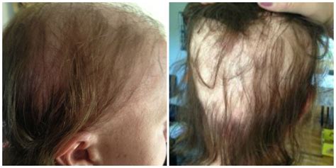 i lost all my hair during pregnancy huffpost