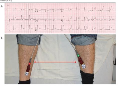 Figure 8 From Common Ecg Lead Placement Errors Part I
