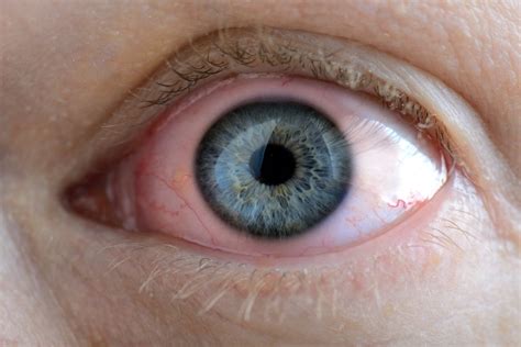Glaucoma Pressure Test In Zeeland Michigan Sight Eye Clinic