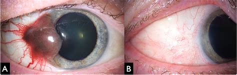 Advances In Conjunctival Melanoma Clinical Features Diagnostic