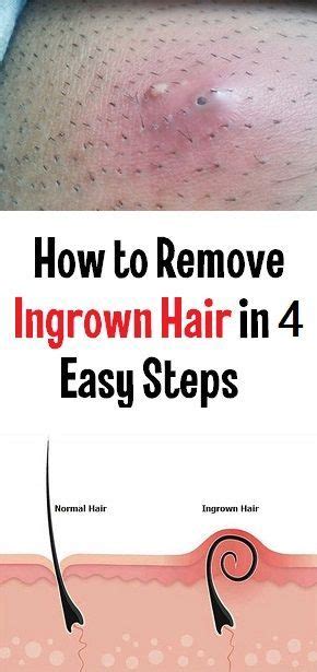 How To Remove Ingrown Hair In Easy Steps Haare Haarfarben Beauty