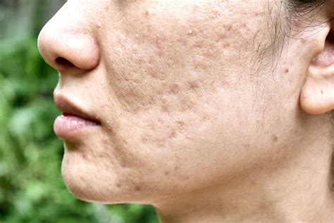 Infini Rf Singapore Effective Treatment For Deep Acne Scars