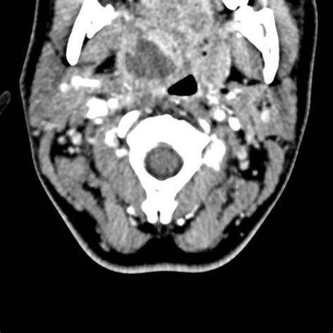 Peritonsillar Abscess Radiology Case