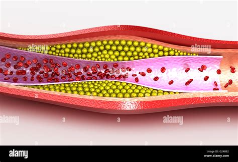 Cholesterol Plaque In Blood Vessel Illustration Stock Photo 104588178
