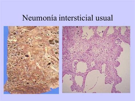 Neumonía intersticial definición causas tipos y más