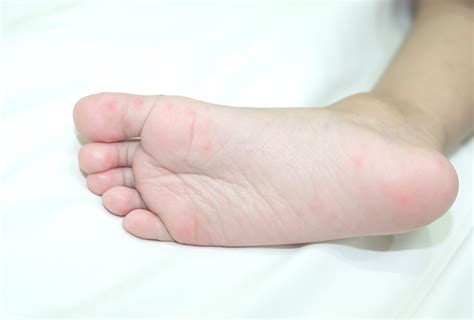 Red Spots On Feet Causes And How To Treat Them Emedihealth