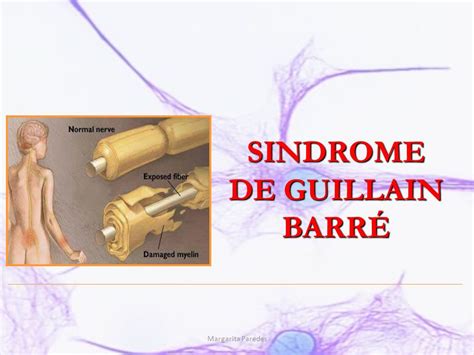 While its cause is not fully understood, the syndrome often follows infection with a virus or bacteria. Síndrome de Guillain-Barre | Salud y Educación Integral