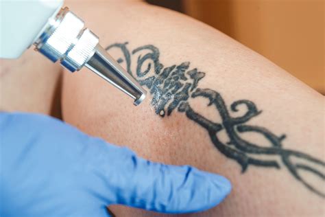 Remoção De Tatuagem Procedimento Está Em Alta Nas Clínicas De Estética