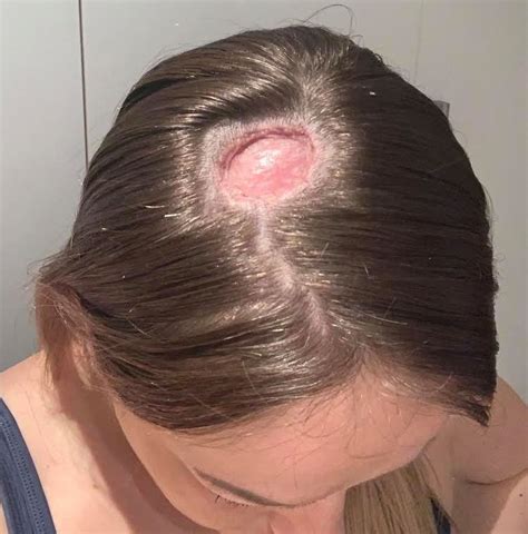 Skin Cancer On Top Of Head