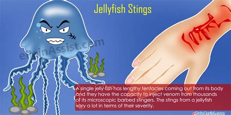Jellyfish Stingssignssymptomsfirst Aidtreatmentprevention