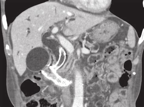 Abdominal Ct Showing Dilatation Of Intrahepatic Bile Duct The Duodenal