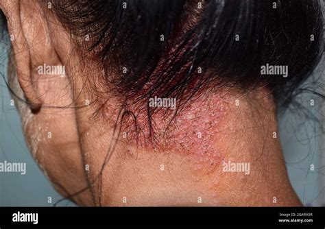 Seborrheic Dermatitis Or Fungal Skin Infection At The Scalp Of Southeast Asian Myanmar Adult