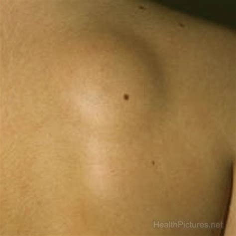 Note that insurance will not always cover the costs of lipoma removal. Lipoma Tips Page 237