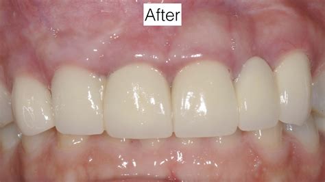 Receding Gum Tissue Around Dental Implant Kazemi Oral Surgery After