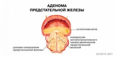 Лечение аденомы простаты - препараты и народные средства. Как лечить Картинка - Лечение аденомы простаты - препараты и народные средства. Как лечить