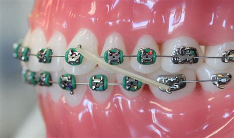 Class Ii Elastics Aligners Laveta Childs