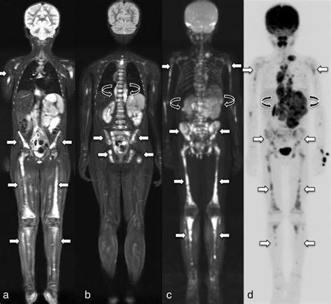 Ten Year Old Male With Neuroblastoma Baseline Whole Body Magnetic