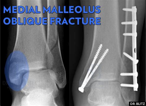 5 Kinds Of Medial Malleolus Ankle Fractures