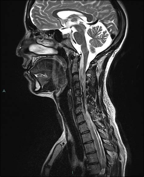 Cervical Thymic Cyst Image