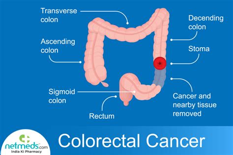 Rectal Cancer Causes Symptoms And Treatment Netmeds