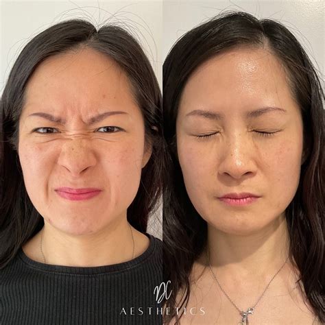 Bunny Lines Anti Wrinkle Injections Gold Coast Dc Aesthetics