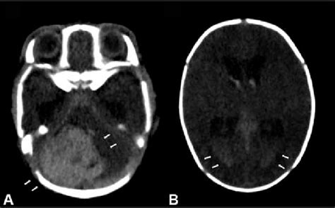 Axial Views Of Ct Scan Showing Hyperdense Round Lesion On The Right