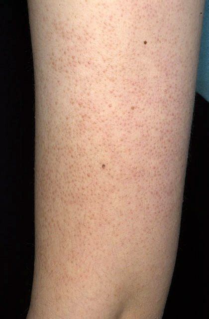 What Is Keratosis Pilaris How To Get Rid Of It Ask The Skin 51 Off