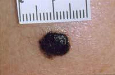 Moles And Skin Cancer Everything You Need To Know Manchester