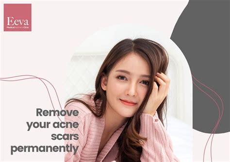 Acne Scar Removal In Singapore Doctors Guide Eeva Medical