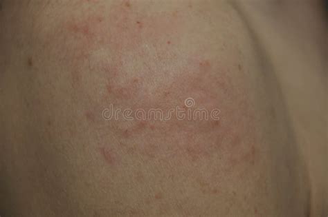 Eczema Pimples On A Shoulder Stock Photo Image Of Female Back 228948632