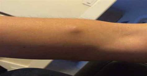 He Had A Bump On His Arm For Yearsand Was Shocked When Doctors