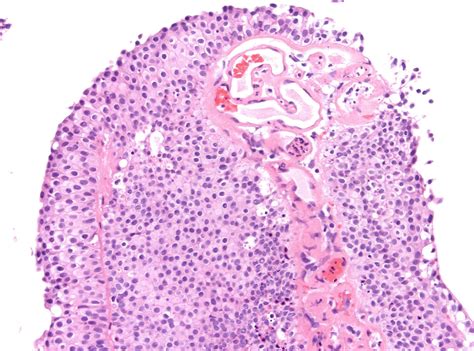 Pathology Outlines Grading Bladder