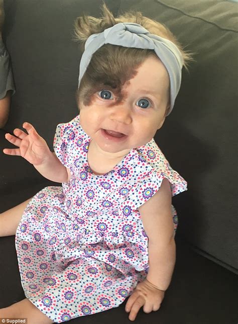 Meet Adorable Baby Born With Dark Birthmark She Will Need 7 Surgeries