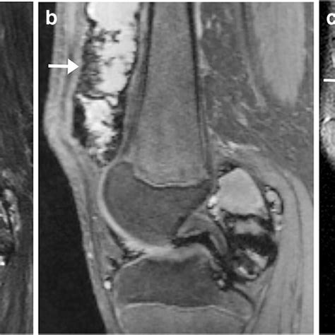 Mri Findings Of Tenosynovial Giant Cell Tumor With Local Erosion A B