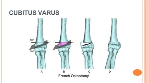 Cubitus Varus And Valgus