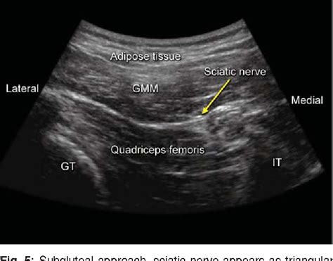 Figure 1 From Ultrasound Guided Sciatic Nerve Block Posterior