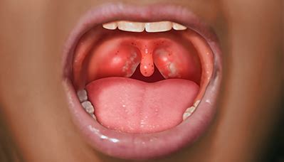 What Is Strep Throat And How Its Spread Health Wellness