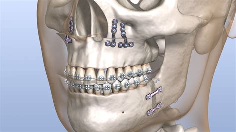 Orthognathic Surgery Montville Oral Surgery