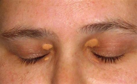 Xanthelasma Nhs