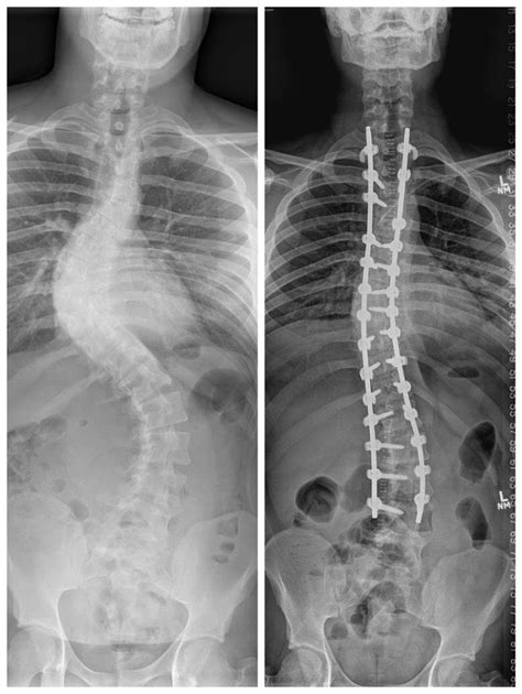 Scoliosis X Ray Before And After
