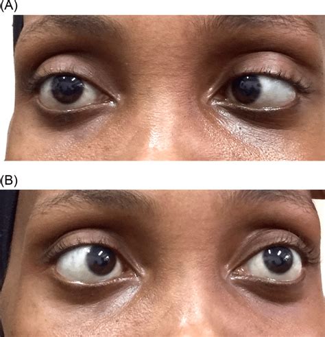 Bilateral Abducens Nerve Palsies A Voluntary Gaze To The Right B