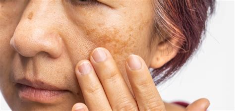 Role Of Primary Care In The Prevention Of Melasma Dermatology Advisor