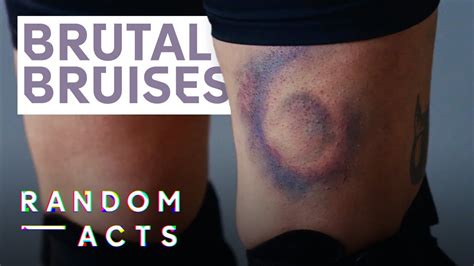 Brutal Bruises From Roller Derby Derby Kiss By Fanny Hoetzeneder Doc Film Random Acts