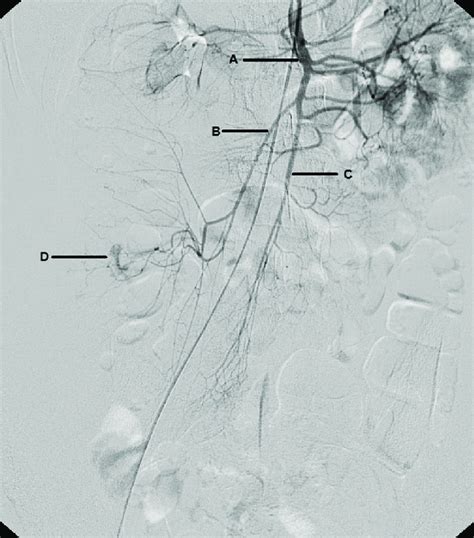 Superior Mesenteric Artery Angiogram Delineating The Anatomy A