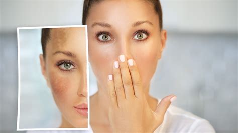 Are You A Victim Of Hyperpigmentation Get Rid Of These 5 Skin Care