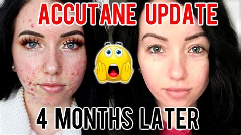 My Accutane Journey 4 Month Update Before And After Progress Side