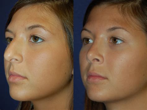 Rhinoplasty Surgery For Dorsal Hump Before And After Photos